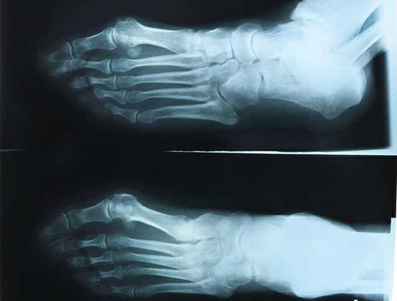bone xray