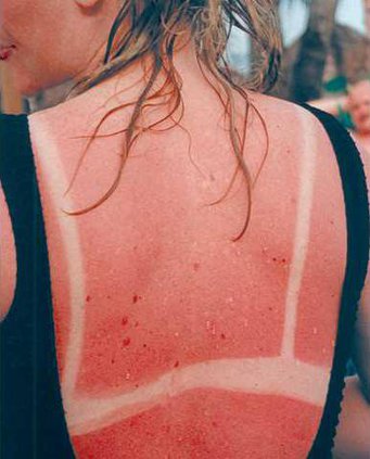 sunburn